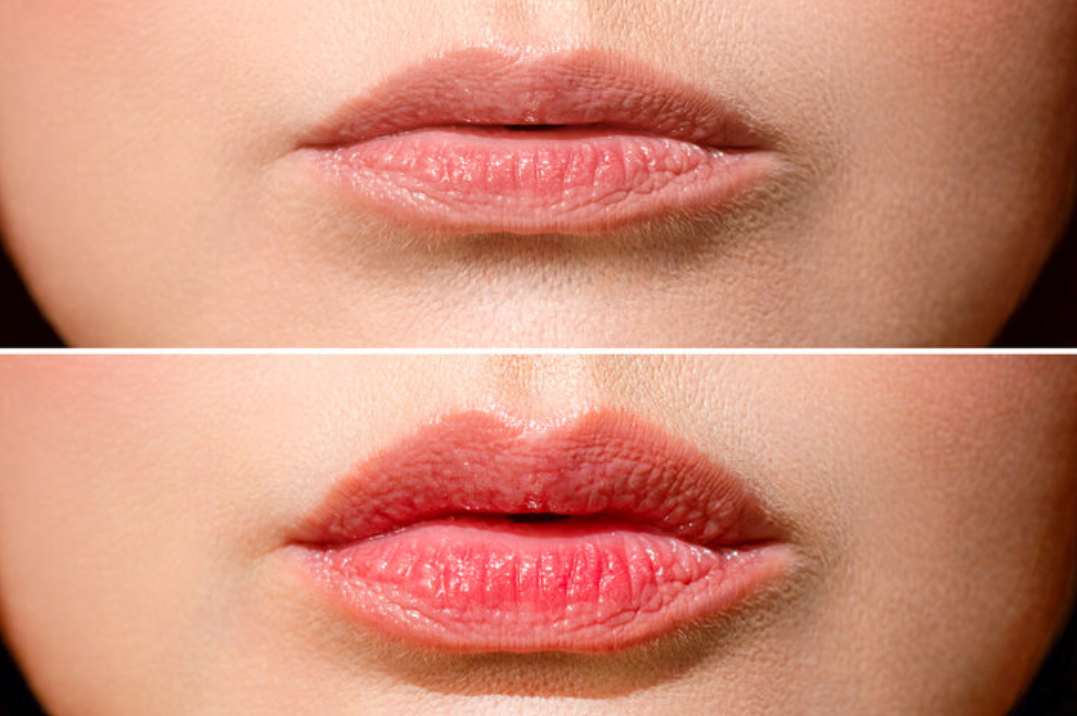Enhance Your Smile with Lip Fillers