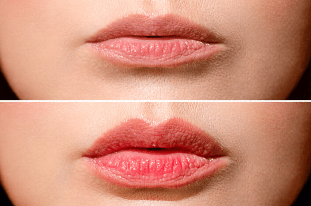Enhance Your Smile with Lip Fillers