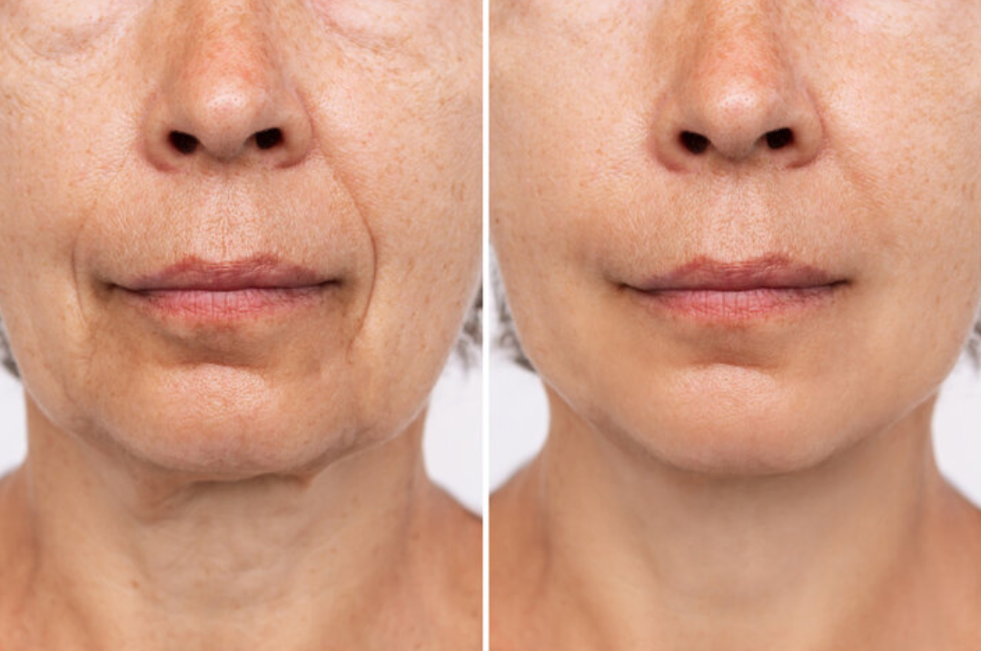 Neck and Décolletage