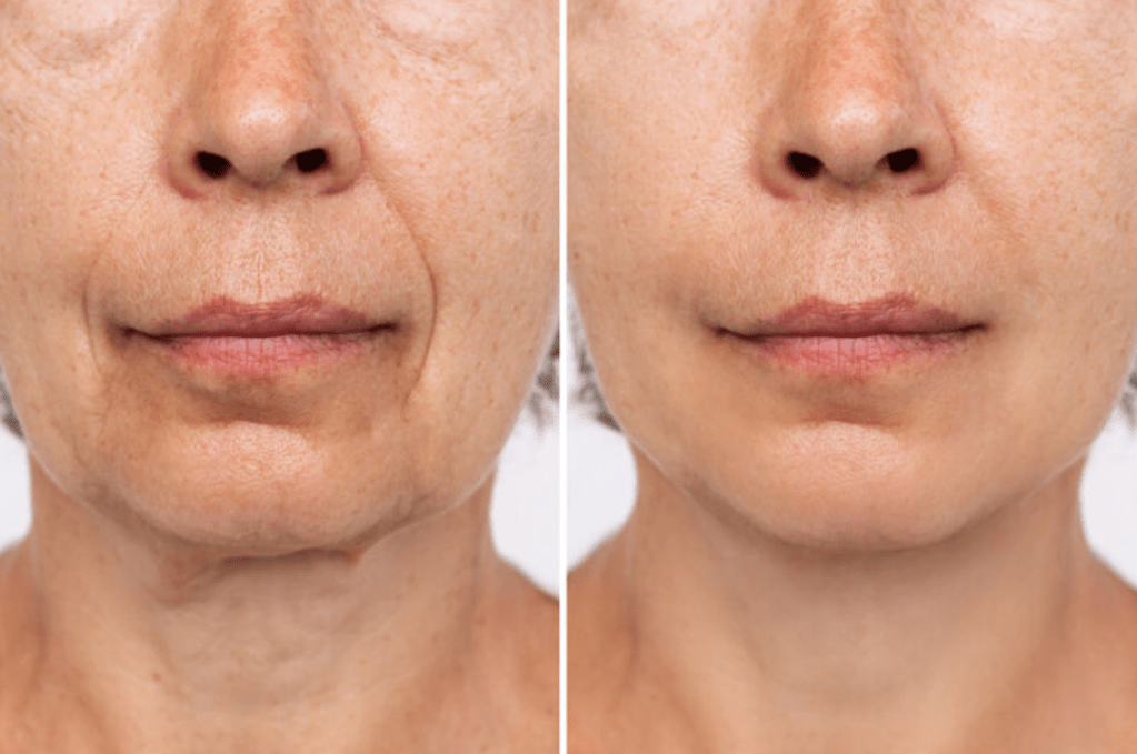 Neck and Décolletage